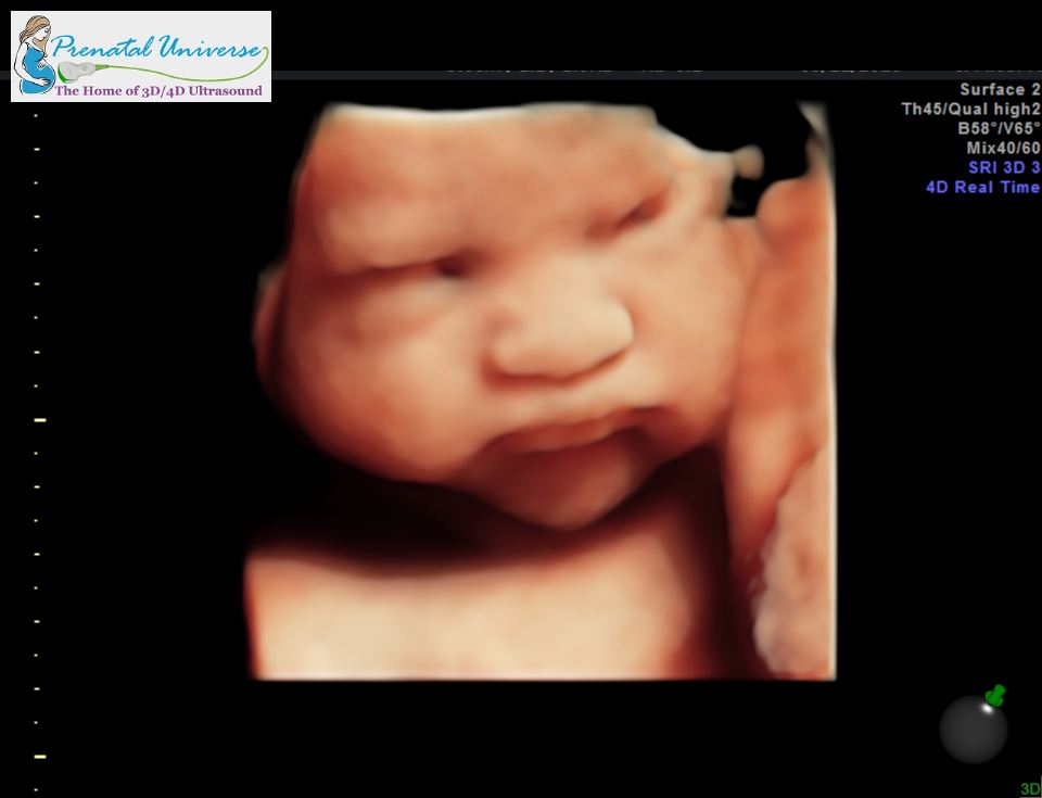 eyes open during 3d ultrasound