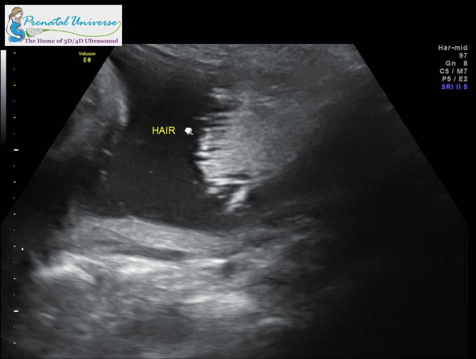 we can see hair using 2D ultrasound