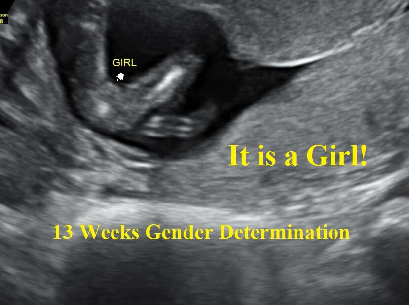 Detect gender when can ultrasound 15 Things