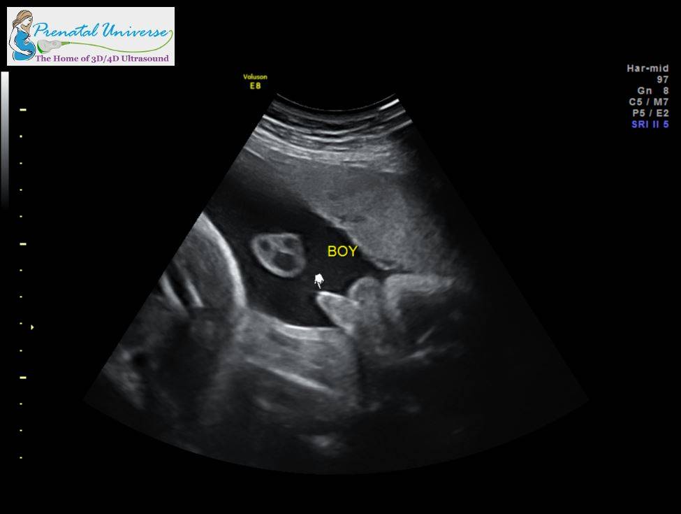 Week gender scan accuracy 15 Gender Ultrasound: